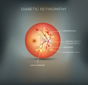 Diabetic Retinopathy In Chicago